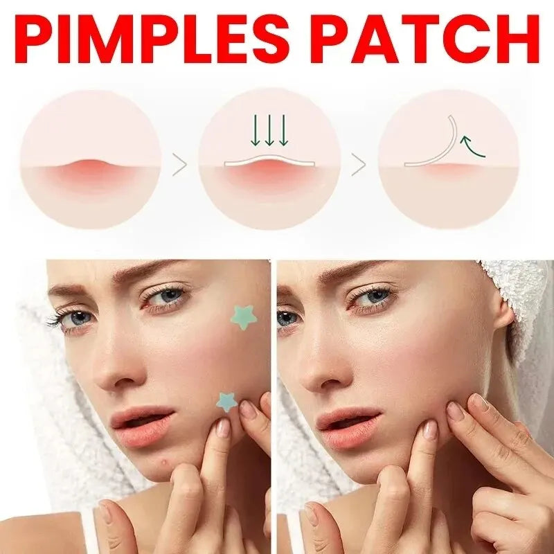 Acne Repair Patches – Fast Healing for Pimples, Blemishes & Marks