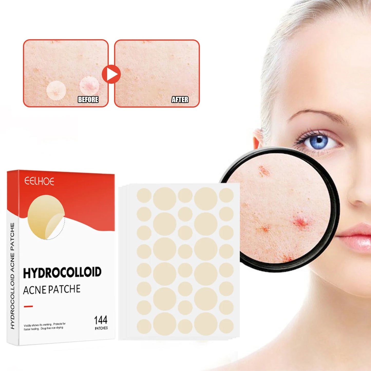 144PCS Invisible Hydrocolloid Acne Pimple Patch Set – Fast Healing Spot Stickers for Men & Women
