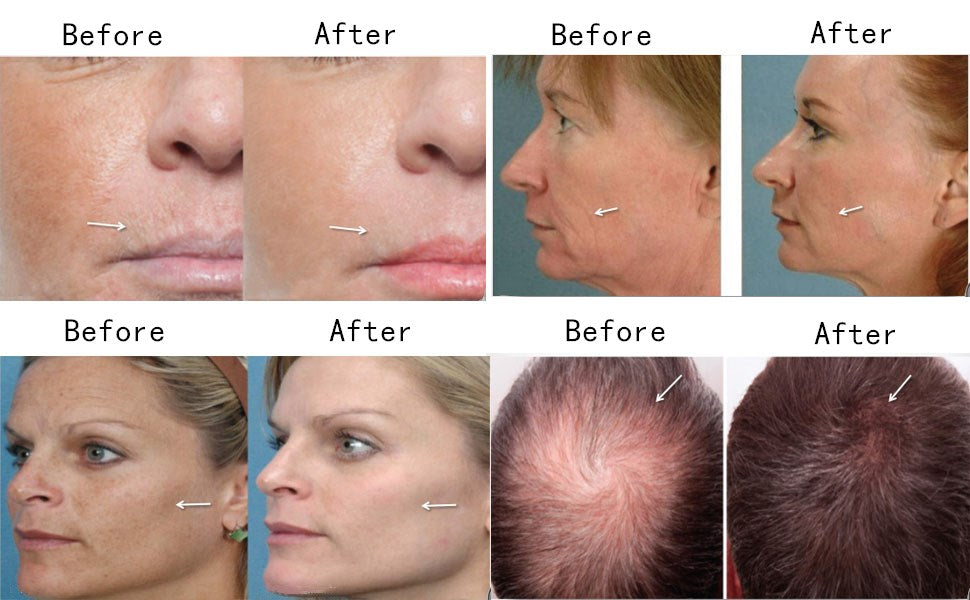 Derma Roller Microneedle Roller For Face and Body