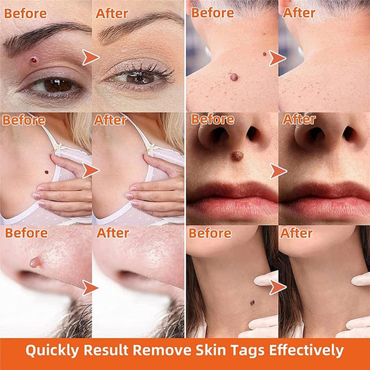 Skin Tag Remover Cream