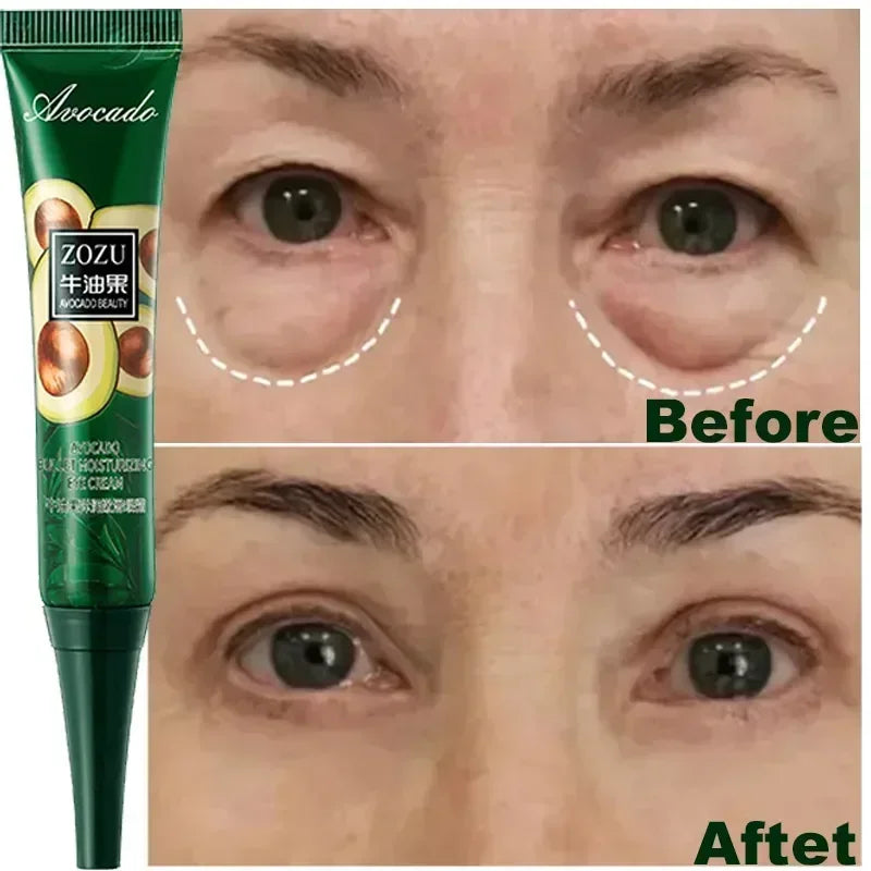 Anti-Aging Avocado Eye Cream – Reduce Wrinkles, Puffiness & Dark Circles Instantly