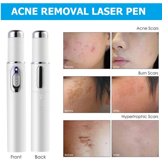 Acne Removal Laser Pen