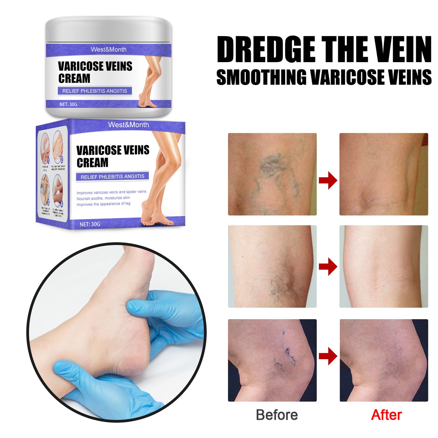 Effective Varicose Veins Relief Cream