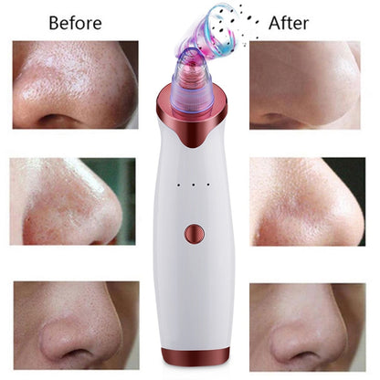 Blackhead Remover Vacuum