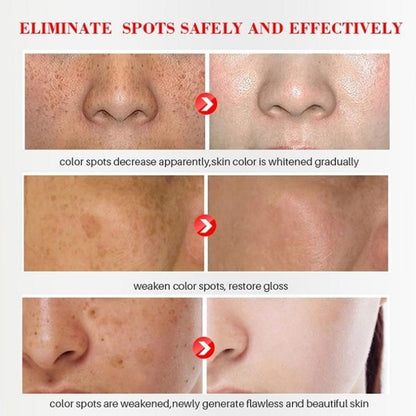 Whitening Freckle Cream