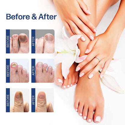 Nail Fungal Treatment Feet Care Essence