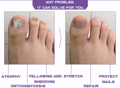 Nail Fungal Treatment Feet Care Essence